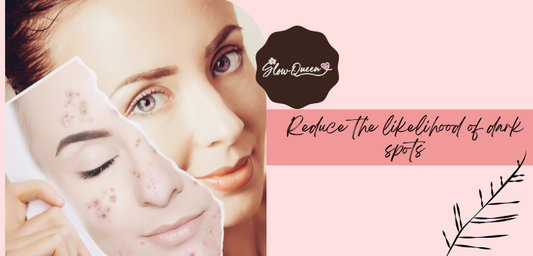 Minimizing Dark Spots: A Guide to Making Your Skin Look Flawless